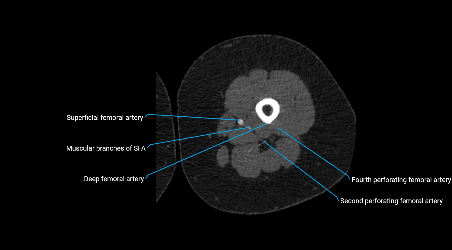 CTA lower limb cross sectional anatomy labelled image _131.webp